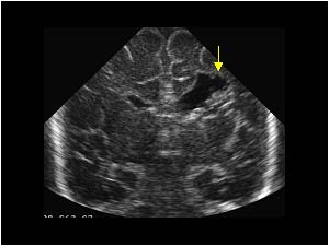 Coronal cystic spaces confluating with the lateral ventricle