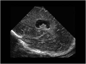 Sagittal cystic spaces confluating with the lateral ventricle