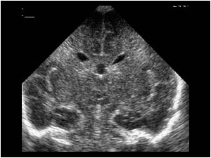 Coronal periventricular hyperechoic areas
