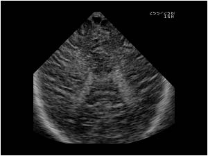 Coronal slit lateral ventricles