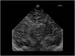 Coronal slit lateral ventricles