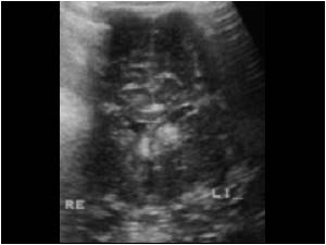 Tuberous sclerosis with a hyperechoic calcified subependymal mass in a 6 months old child