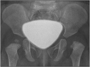 Femoral head necrosis as a complication of developmental dysplasia of the hip