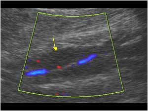 Thrombus filled calf veins without flow parallel the artery longitudinal