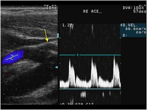 External carotid artery with side branch and normal doppler spectrum