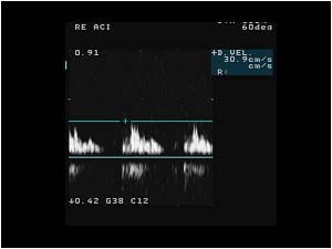 Post stenotic doppler signal
