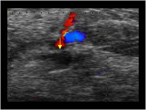 Thrombus filled calf vein without flow transverse