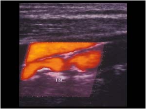 Powerdoppler image of the stenosis