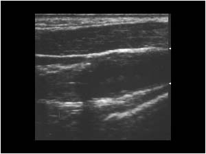 Internal carotid artery occlusion with back and forth flow in the common carotid artery. No flow in the internal carotid artery.