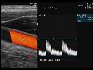 Normal doppler spectrum in the left common carotid artery