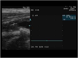 No flow in the right internal carotid artery