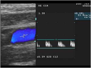 Abnormal high resistance doppler spectrum in the right common carotid artery