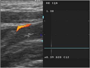 No flow in the right internal carotid artery