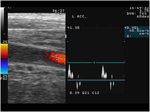 Common carotid artery dissection with abnormal pre occlusive doppler spectrum