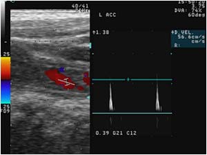 Common carotid artery dissection with abnormal pre occlusive doppler spectrum