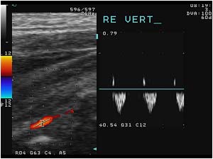 Inverted flow in the right vertebral artery