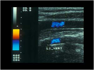 Normal flow in the left vertebral artery compared to the common carotid artery