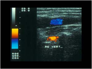 Inverted flow in the right vertebral artery compared to the common carotid artery