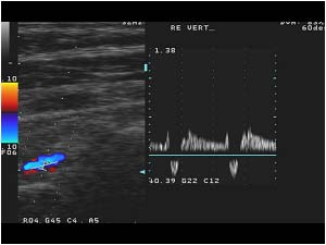 Transient subclavian steal with bidirectional flow in the right vertrebral artery