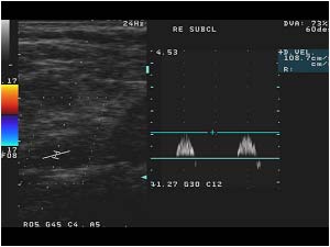 Abnormal post stenotic doppler spectrum in the distal right subclavian artery
