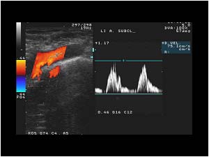 Abnormal doppler spectrum in the distal left subclavian artery