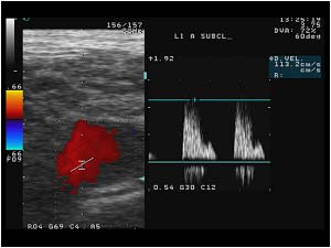 Abnormal pre occlusive flow in the left subvlavian artery