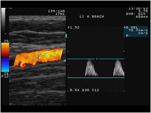Abnormal post occlusive spectrum in the left distal brachial artery