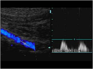 Post stenotic doppler signal in the distal common iliac artery