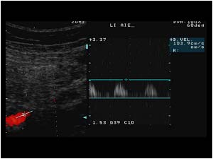 Post stenotic doppler signal in the external iliac artery