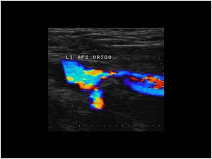 Stenosis in the proximal superficial femoral artery