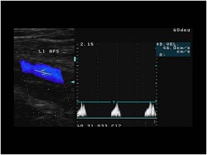 Post stenotic signal distal in the superficial femoral artery