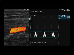 Doppler signal in the proximal superficial femoral artery