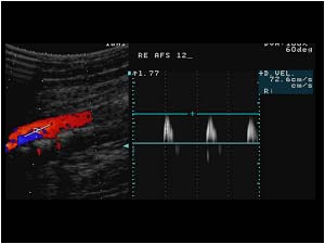 Doppler signal in the proximal superficial femoral artery