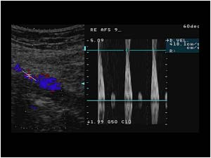 High velocities in the stenosis