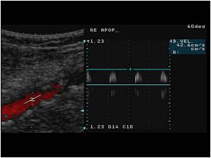 Post stenotic doppler signal in the popliteal artery