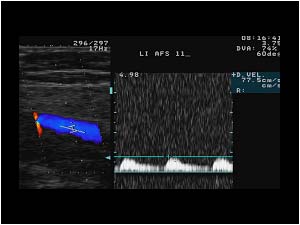 Post stenotic doppler signal in the distal superficial femoral artery