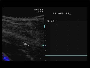 No flow in the occluded proximal superficial femoral artery