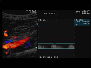 Post occlusion doppler signal in the popliteal artery