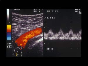 High diastolic flow in the common femoral artery