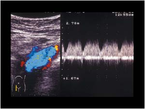 Pulsatile flow in the common femoral vein