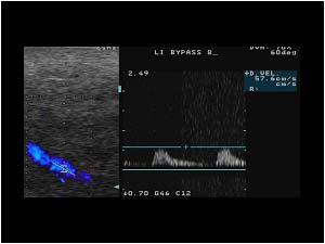 Post stenotic doppler signal in the distal bypass