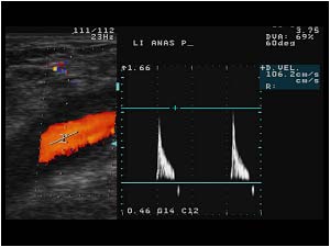 Pre occlusion doppler signal in the origin of the bypass