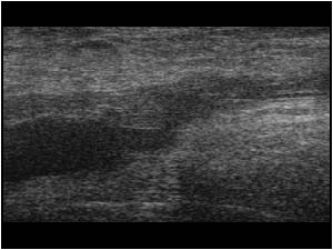 Thrombus in the greater saphenous vein extending in the common femoral vein longitudinal