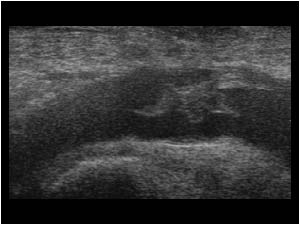 Thrombus extending in the common femoral vein longitudinal