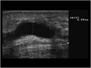 Aneurysm in the ulnar artery longitudinal