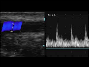 Low resistance doppler signal in the radial artery