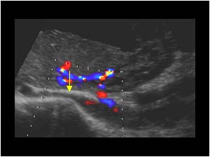 Compression of the common iliac vein during pregnancy