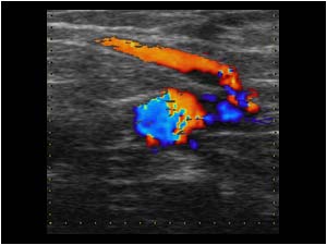 Collateral vein in the groin