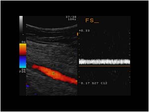 Normal flow in the superficial femoral vein