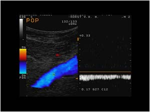 Normal flow in the popliteal vein